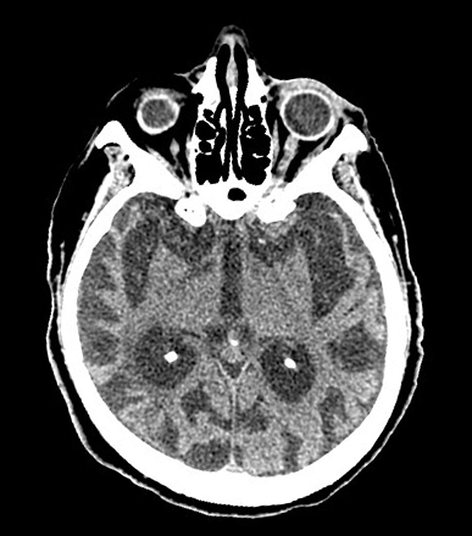 CT of Alzheimer Disease