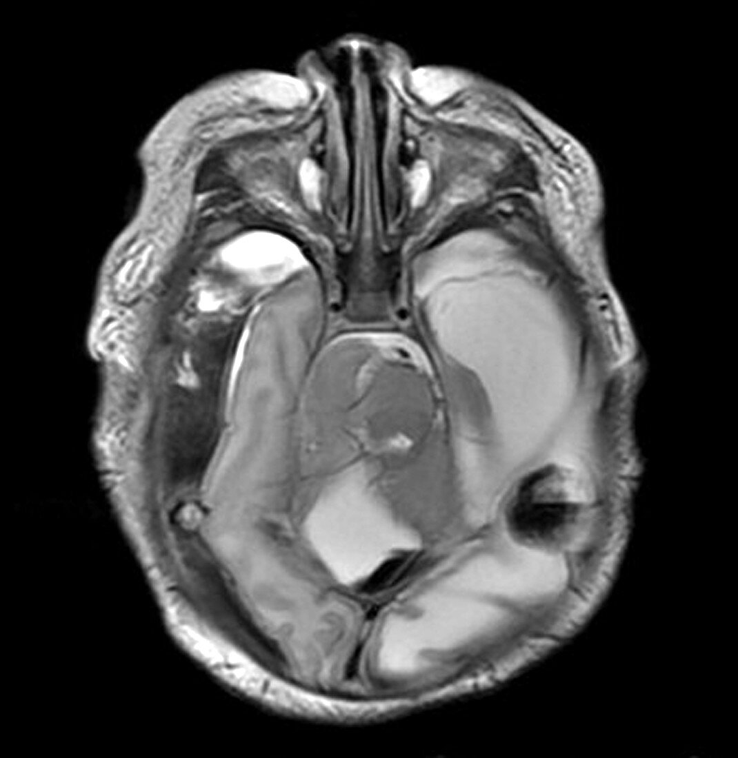 Extensive Birth Injury MRI