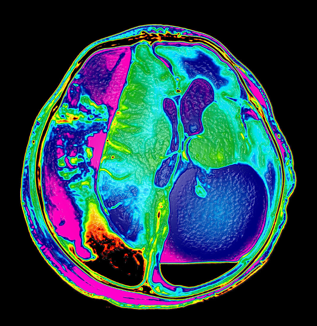 Enhanced Extensive Birth Injury MRI