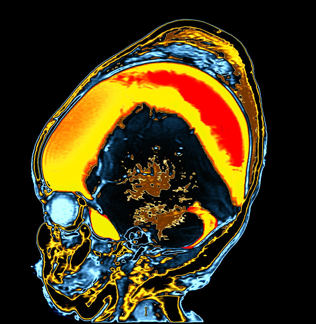 Enhanced MRI of Extensive Birth Injury