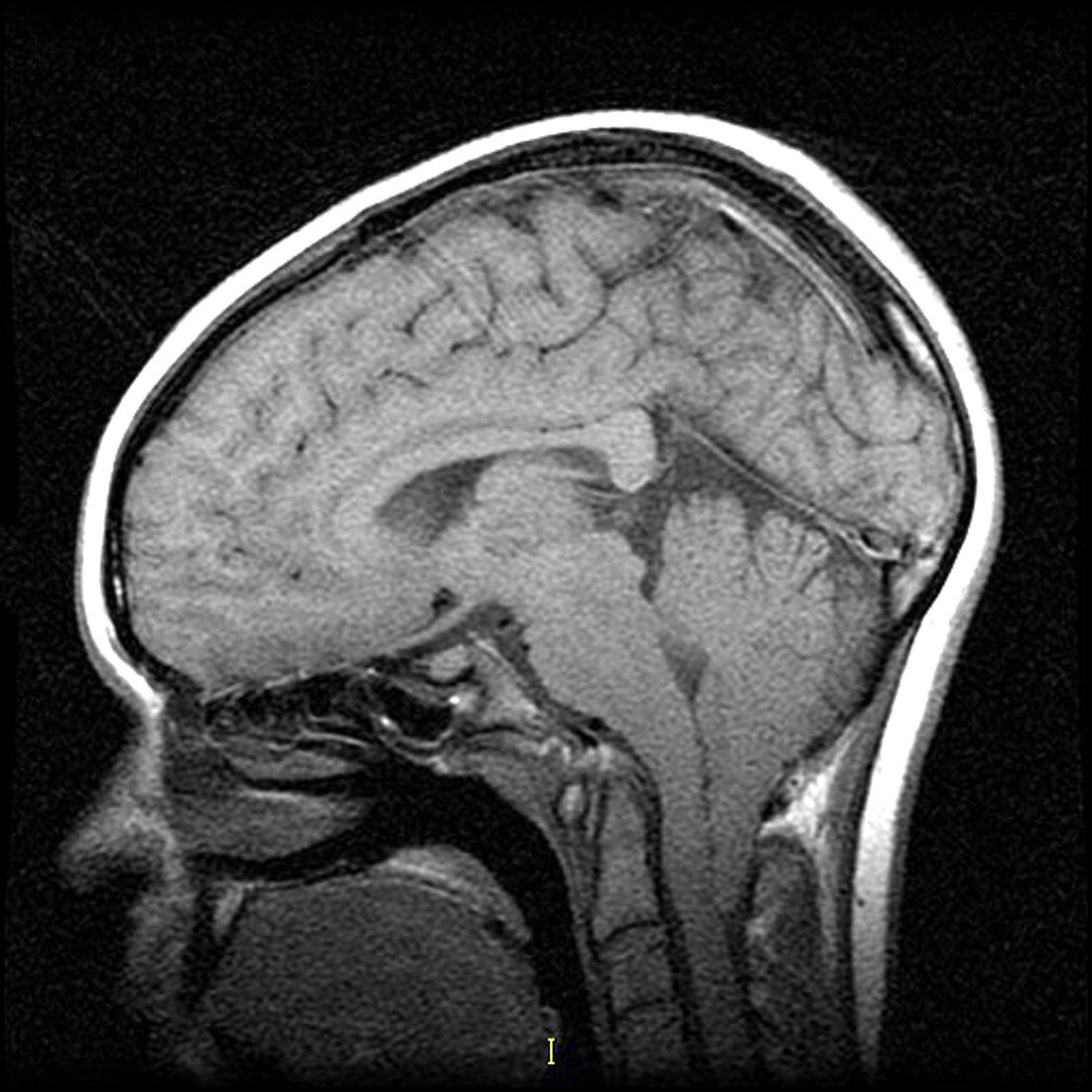 MRI of Severe Chiari I Malformation