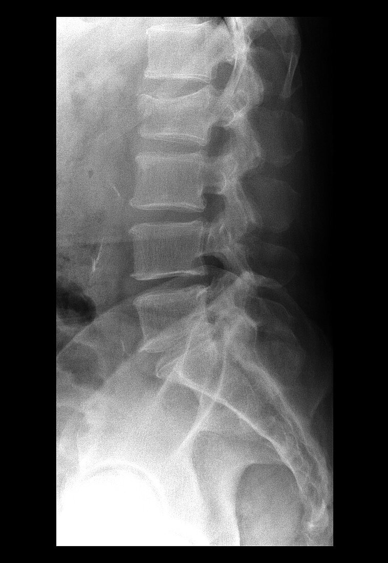 Acute Compression Fracture of L2