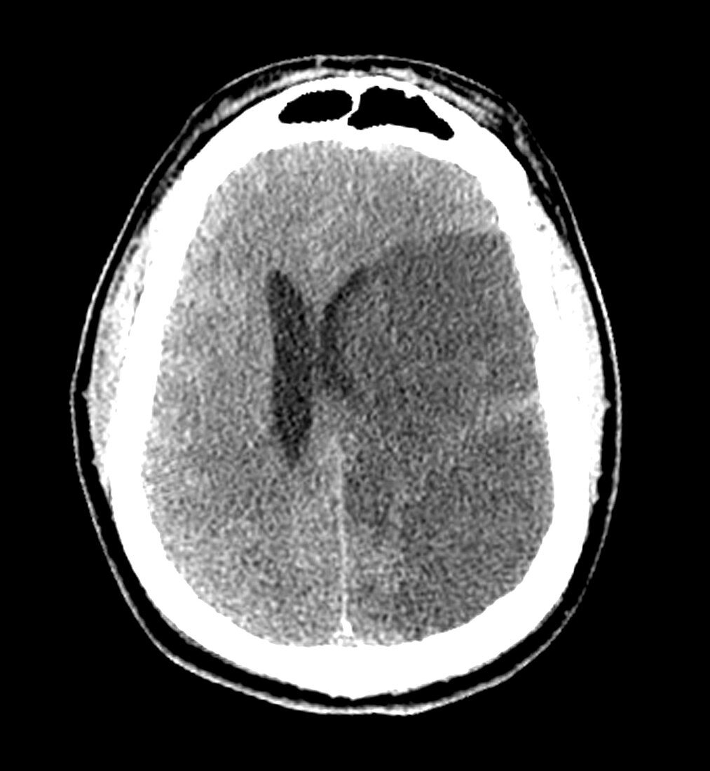 Large Acute Stroke with Craniotomy
