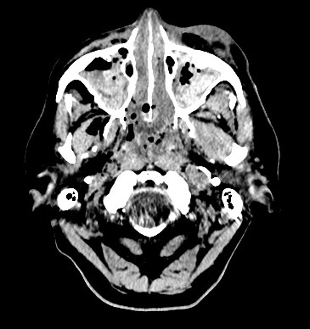 Extensive Traumatic Brain Injury CT