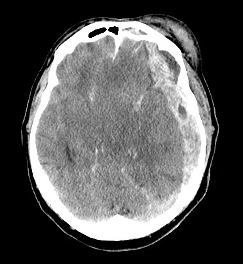 Extensive Traumatic Brain Injury CT