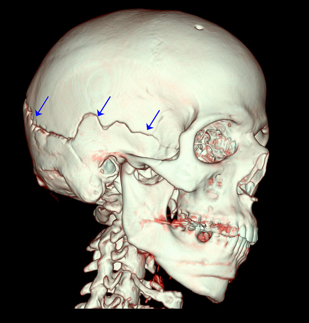3D CT of Skull Fracture