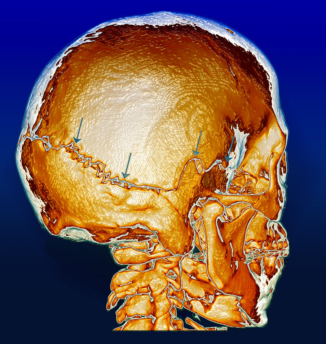 Enhanced 3D CT of Skull Fracture