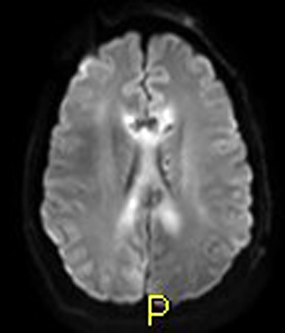Severe Traumatic Brain Injury,MRI