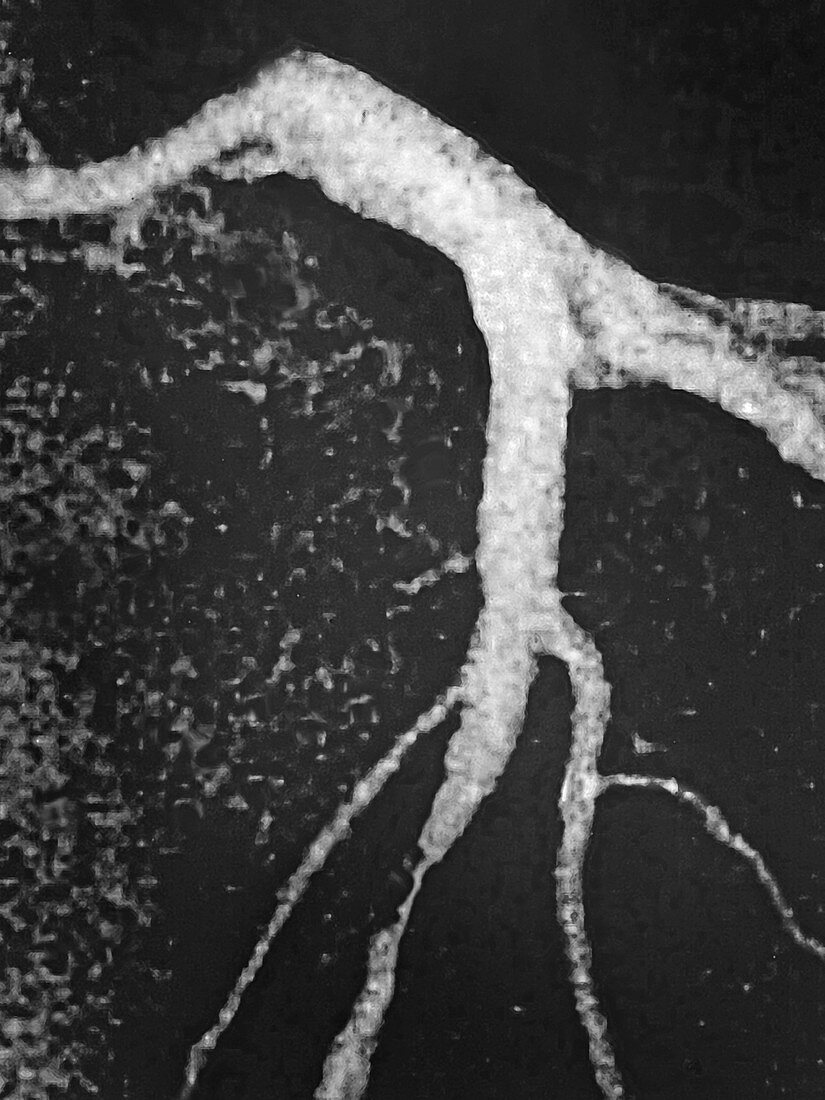 Myocardial Infarction,Angiogram