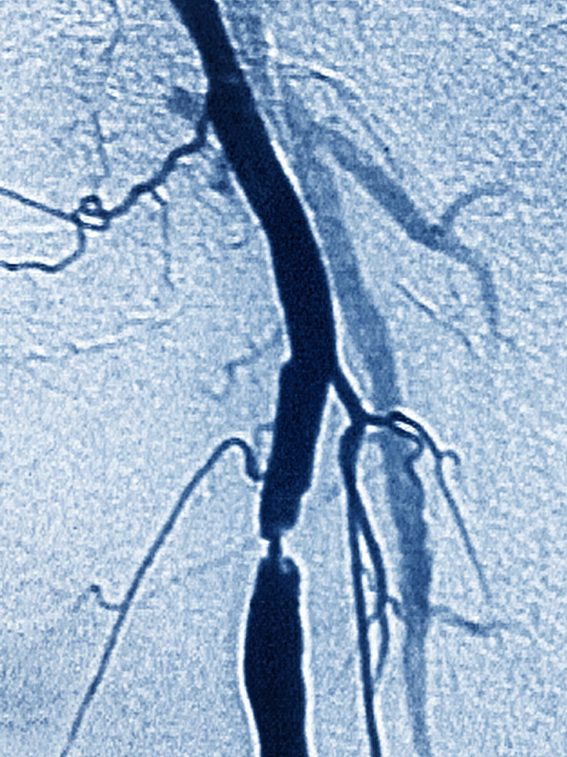 Stenosis on Iliac Artery