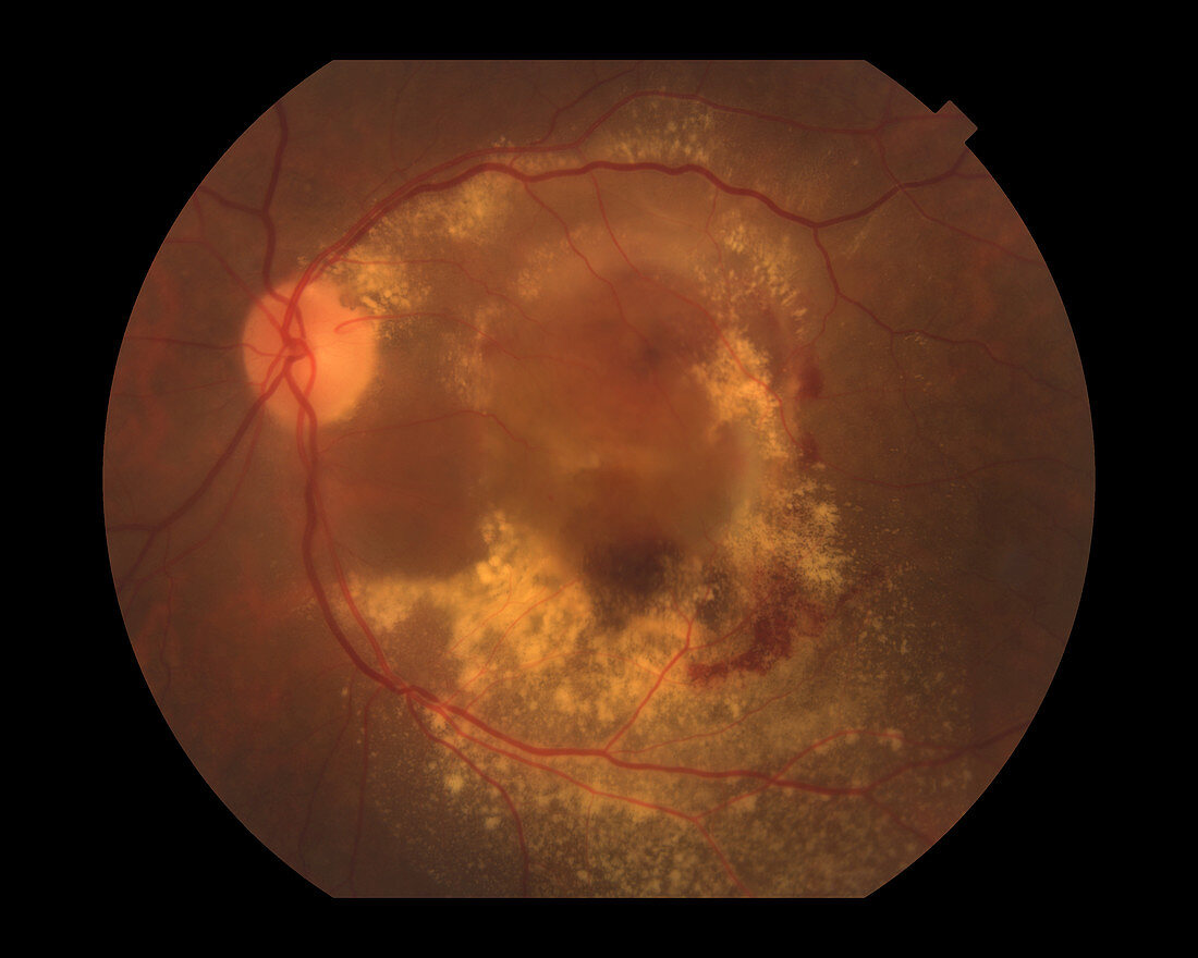 Wet Age-Related Macular Degeneration