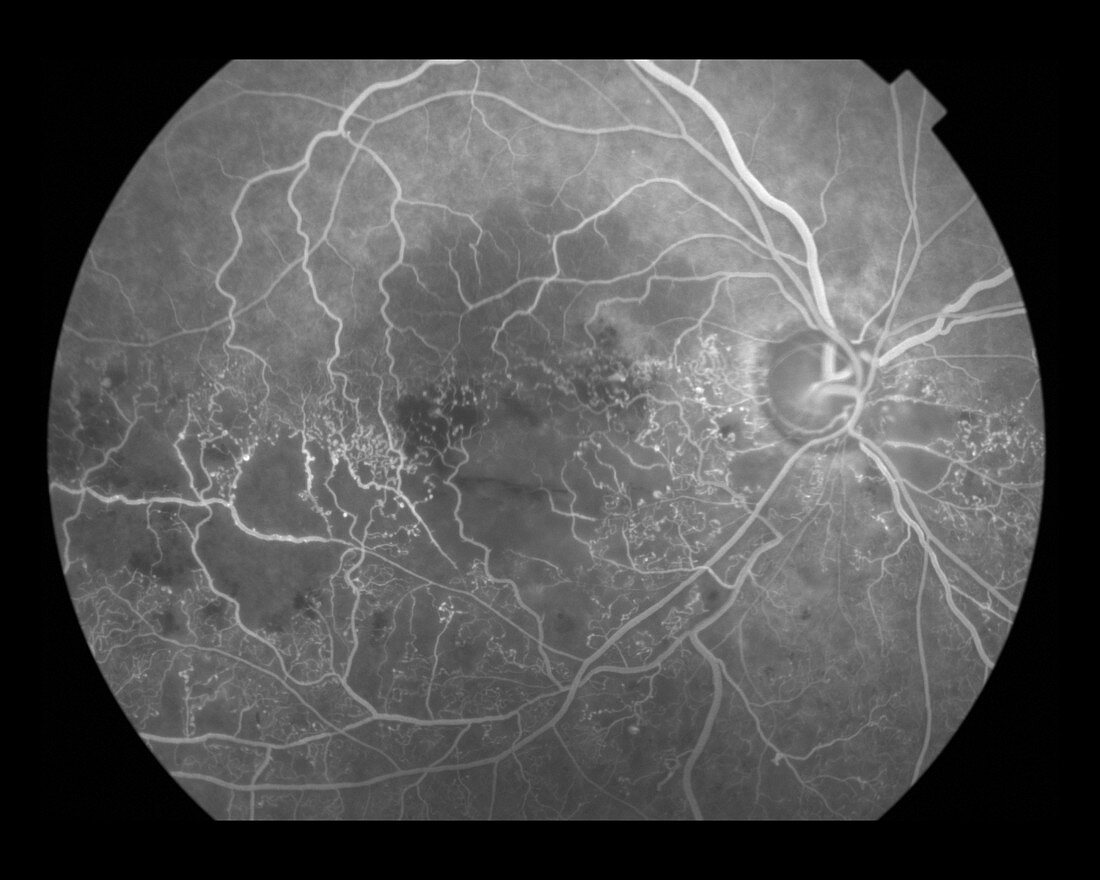 Hemi-Central Retinal Vein Occlusion
