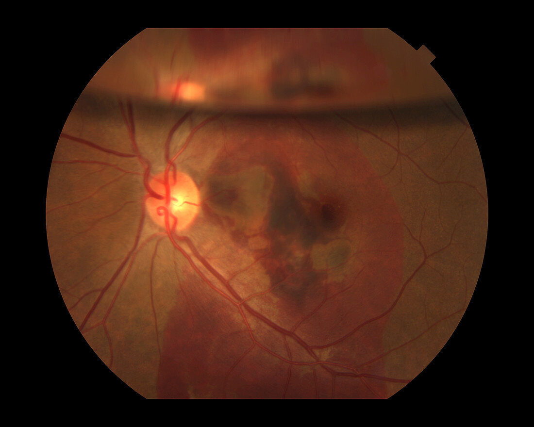 Intraocular Gas Bubble