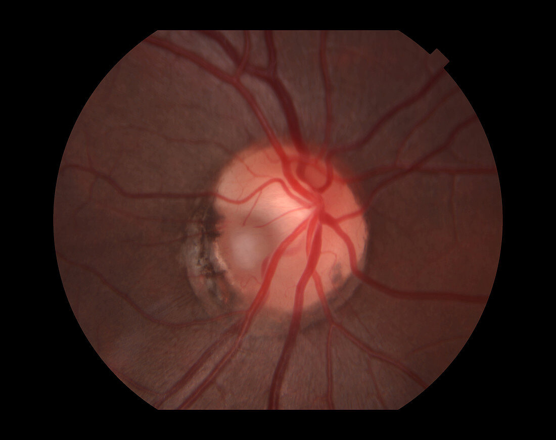 Congenital Optic Nerve Pit