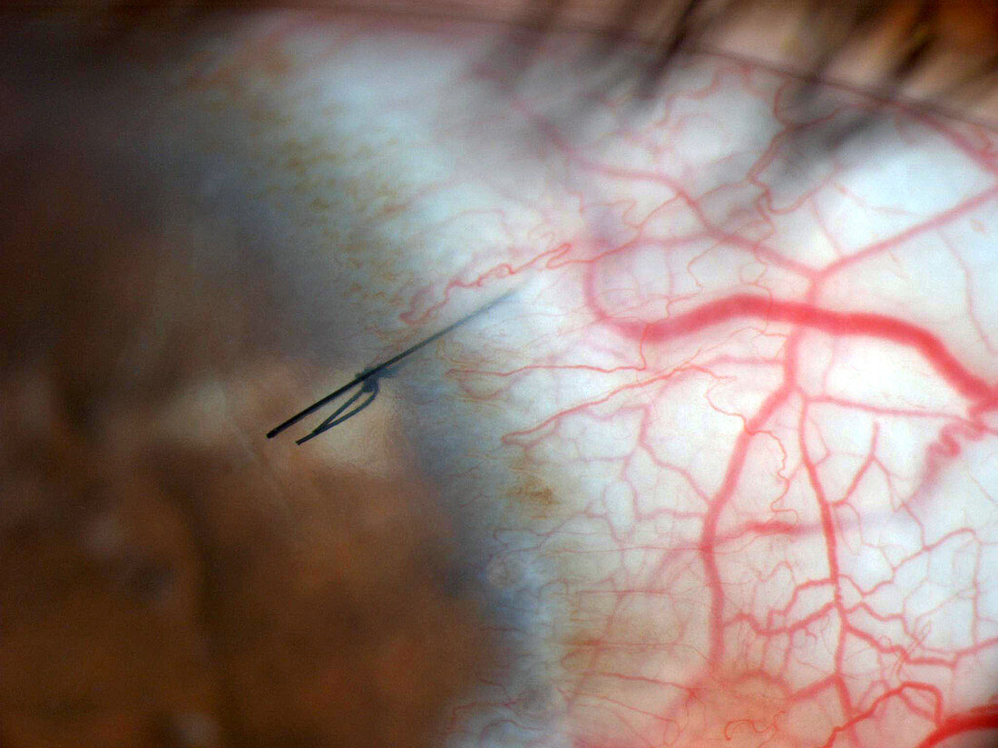 Corneal Suture