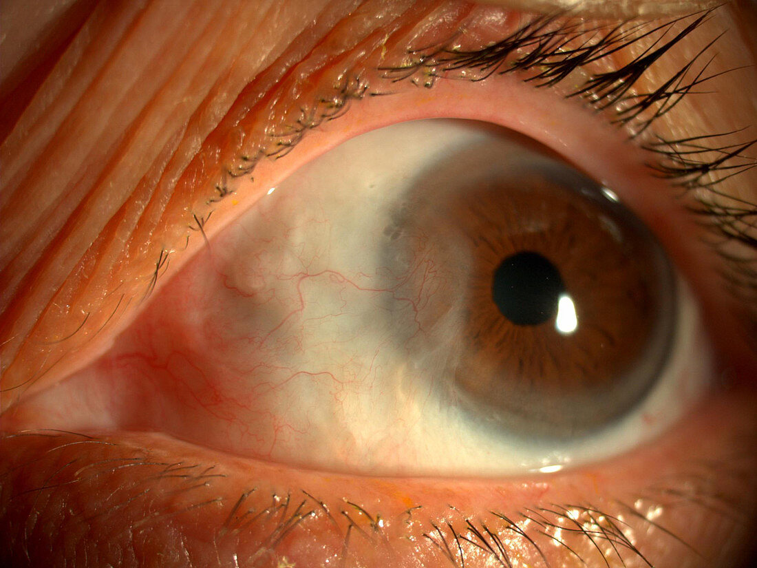 Pterygium