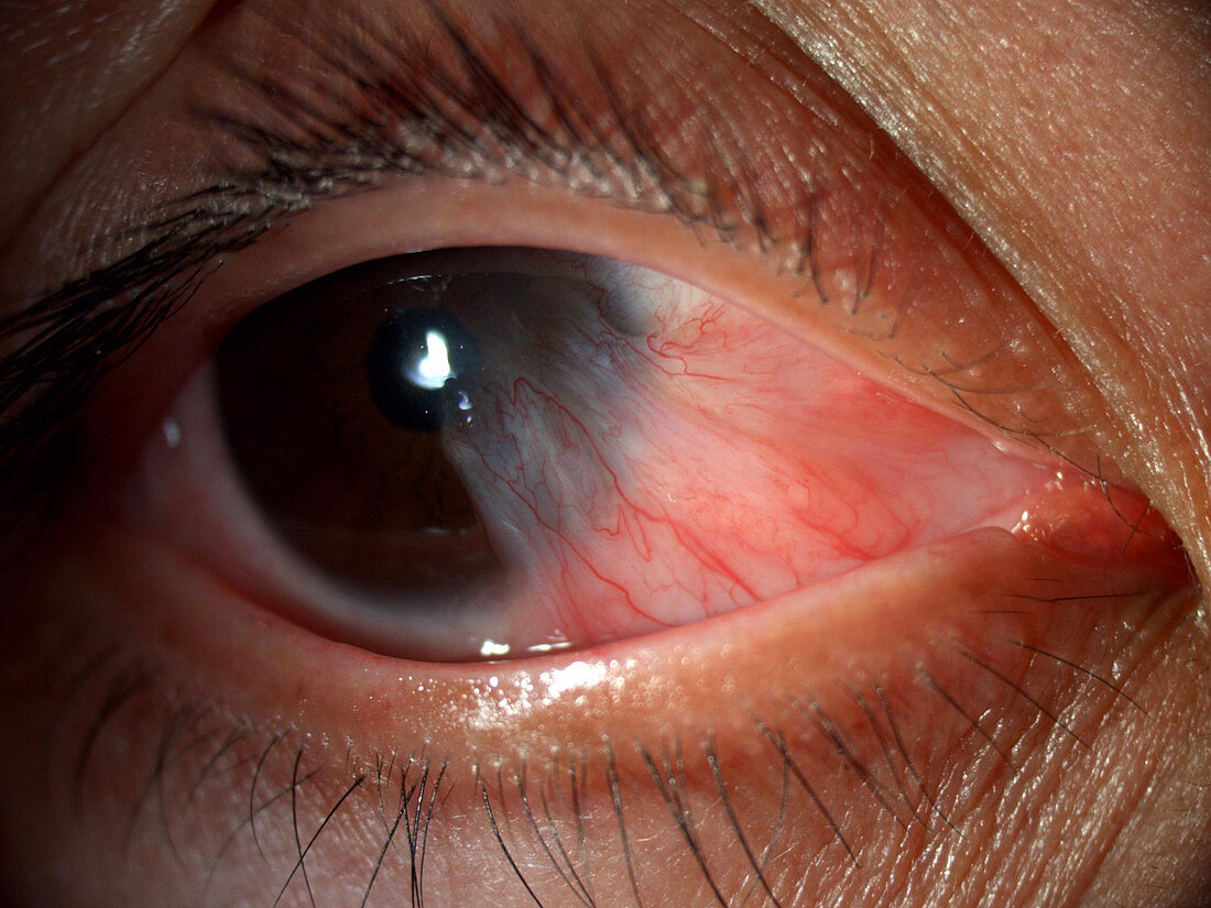 Pterygium