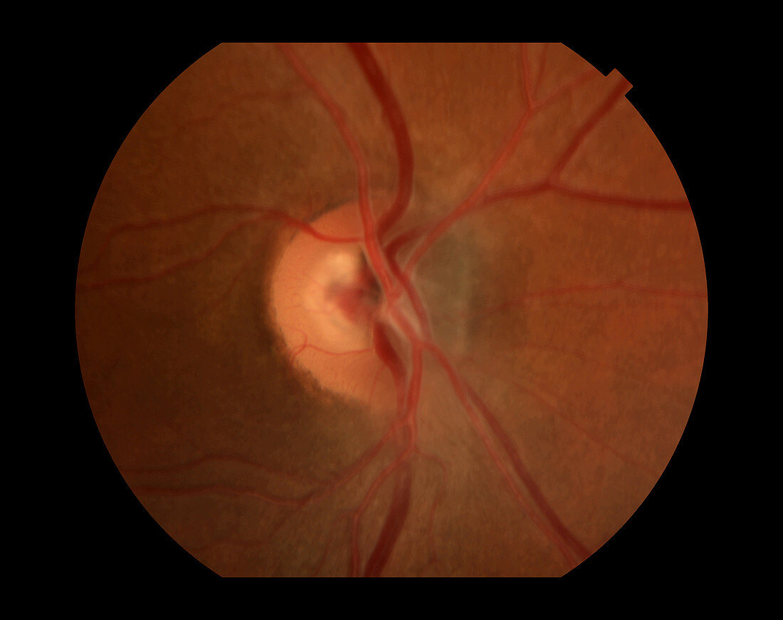 Optic Nerve Melanoma