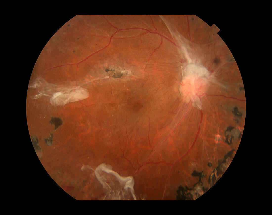 Proliferative Diabetic Retinopathy