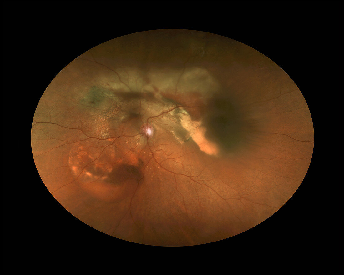 Ocular Tuberculosis