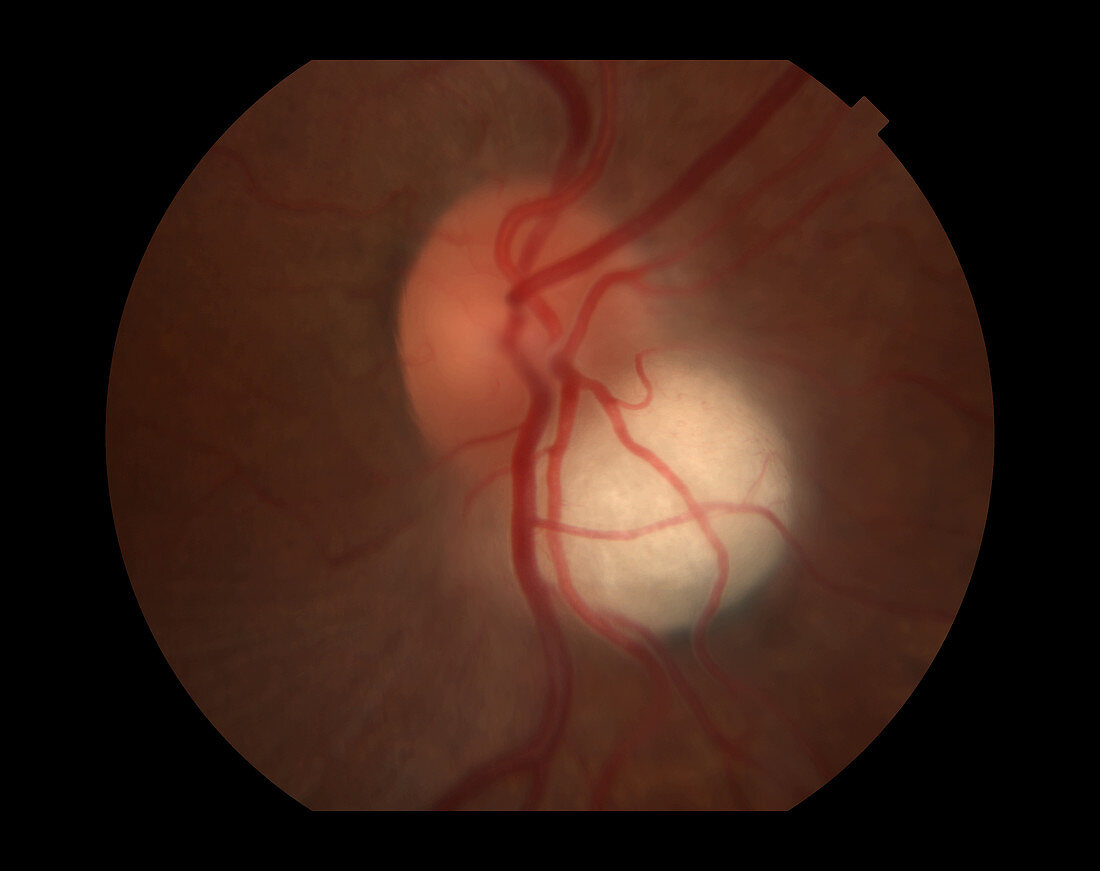 Astrocytic Hamartoma