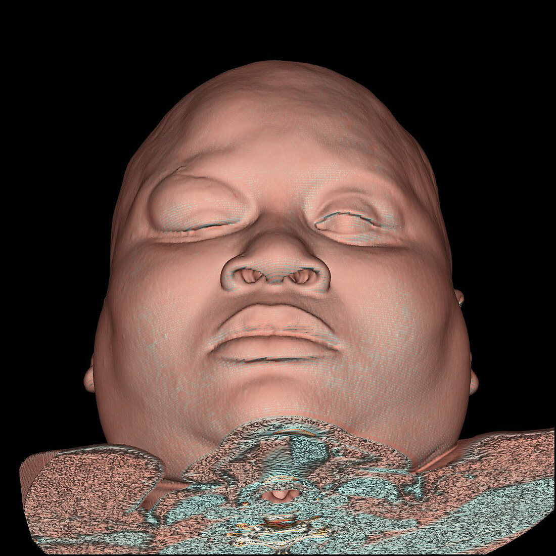 3DCT Image of Facial Trauma
