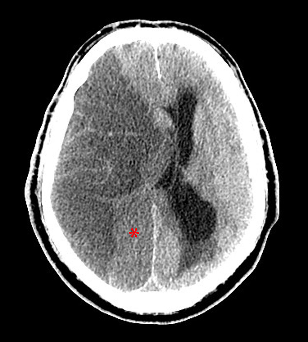 Large Stroke,CT Scan