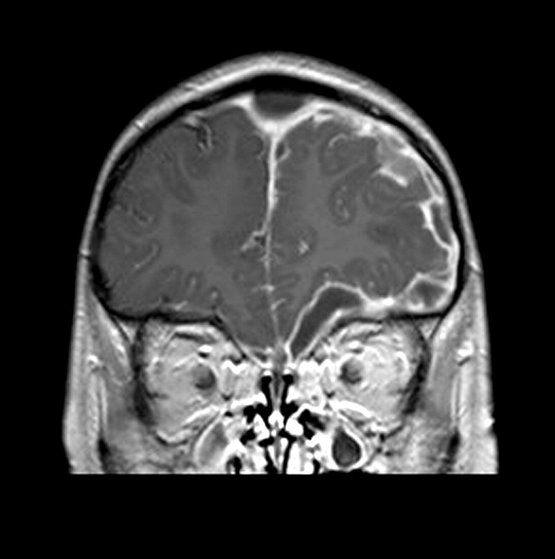 Sinusitis with Empyema,MRI
