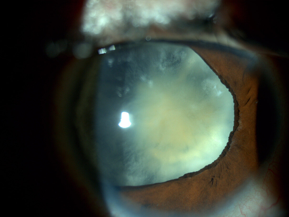 Cataract