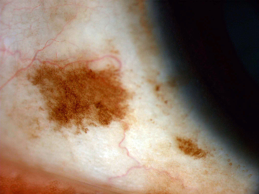 Scleral Nevus