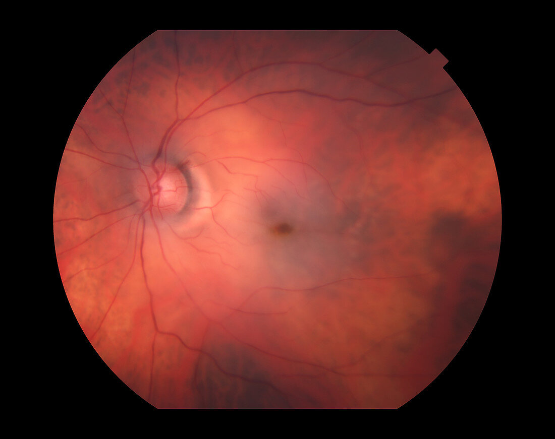 Central Retinal Artery Occlusion