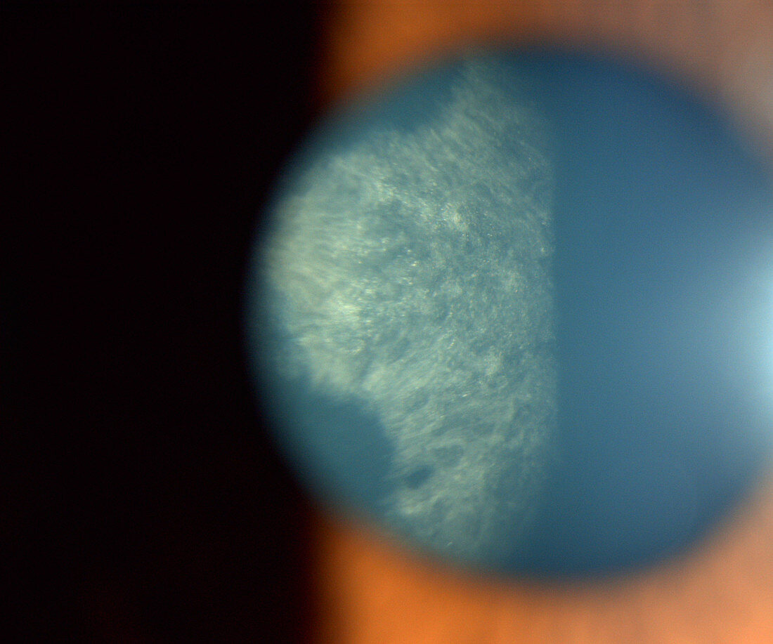 Cataract