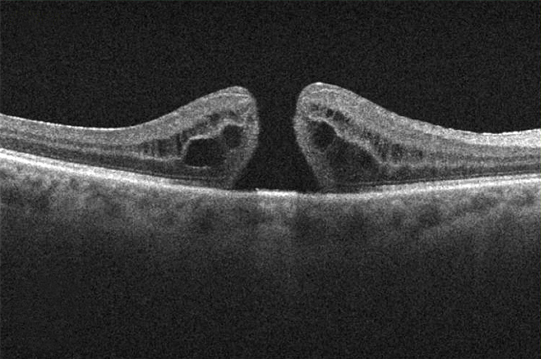 Macular Hole