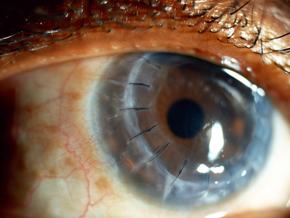 Corneal Transplant