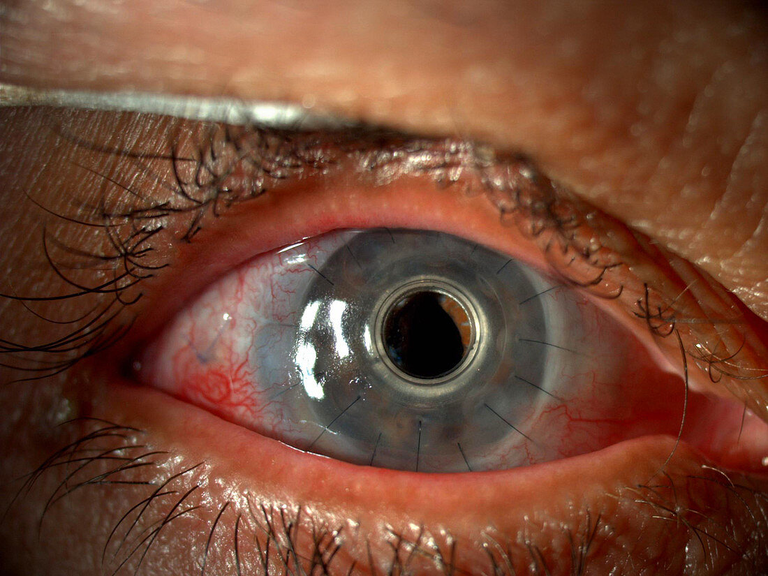 Corneal Implant