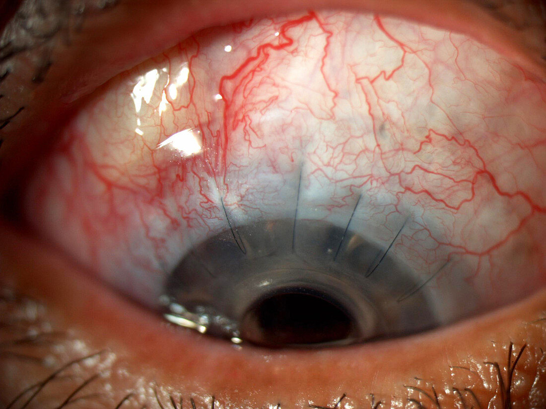 Corneal Implant