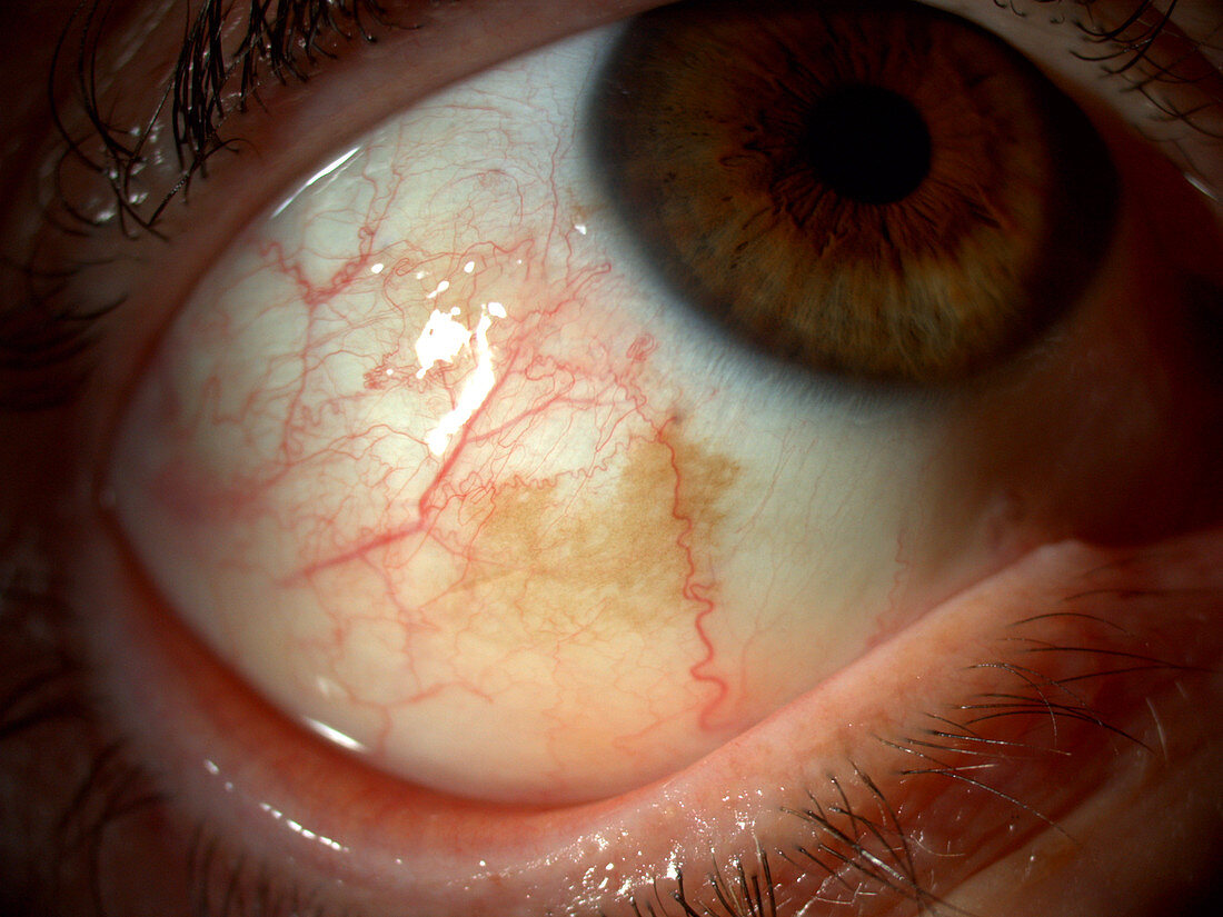 Scleral Pigment