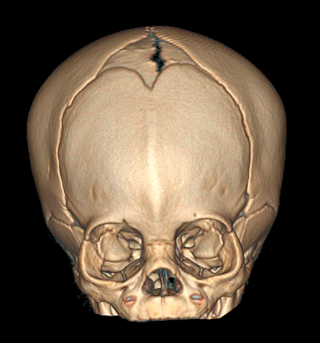 Trigononcephaly,3D CT Scan