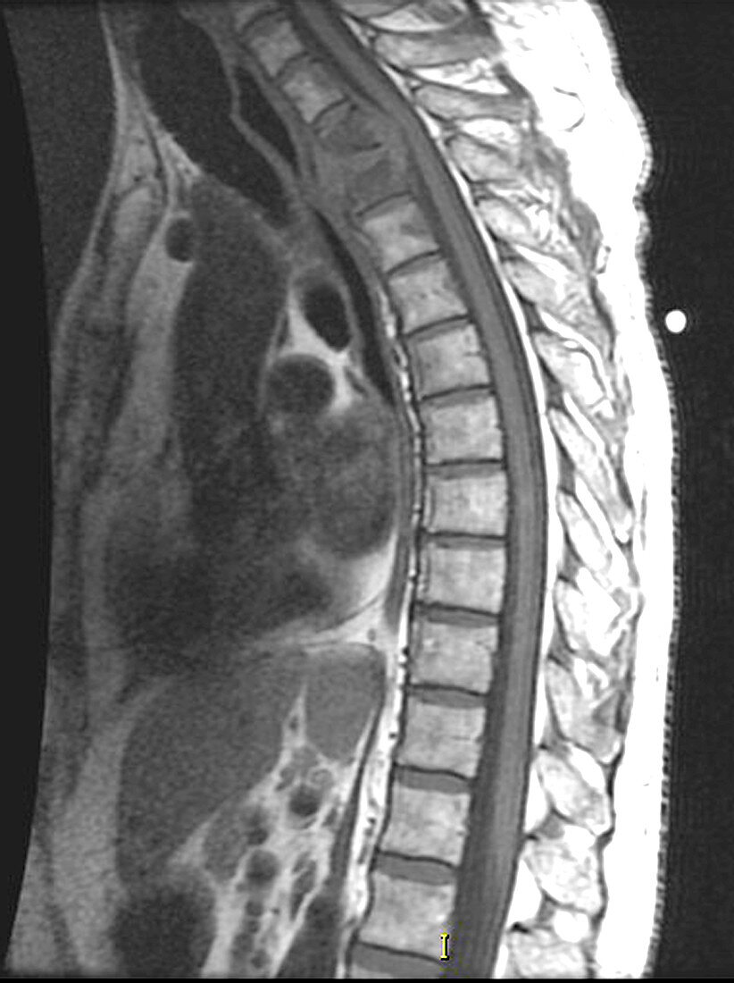 Spinal Infection,MRI