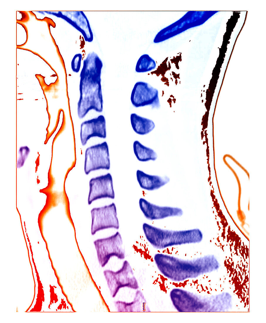 Sickle Cell Osteopathy,CT Scan