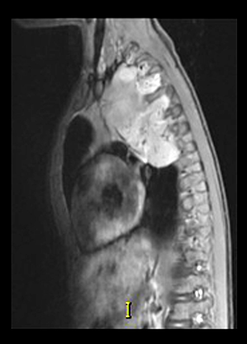 Neuroblastoma in Child,CT Scan
