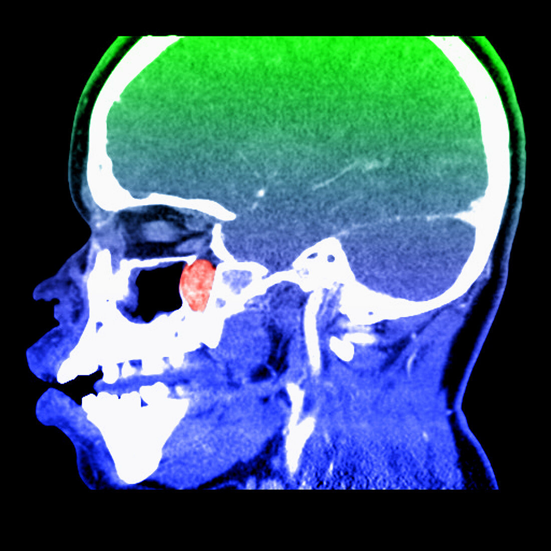 Nasopharyngeal Angiofibroma,CT Scan