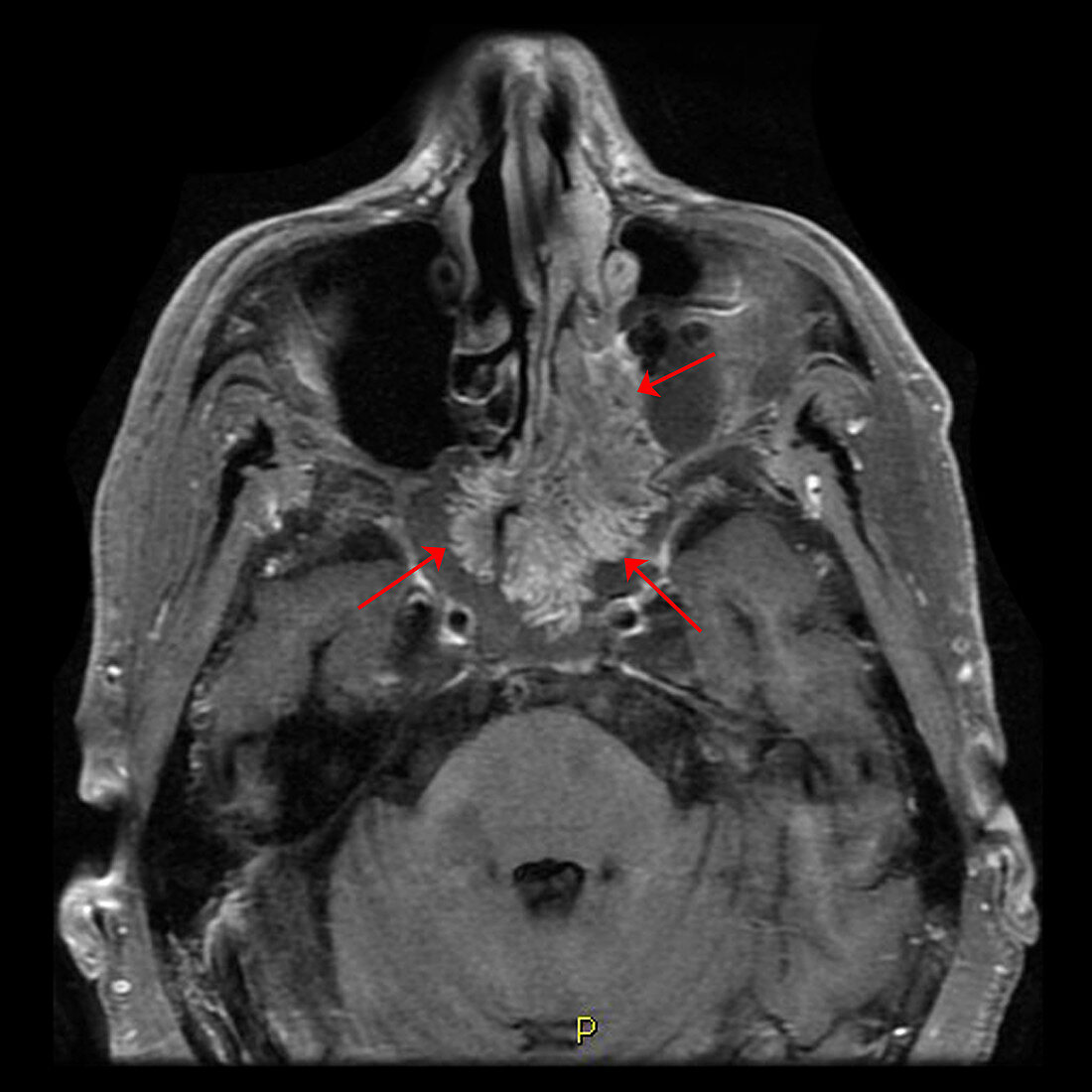Inverted Papilloma,MRI