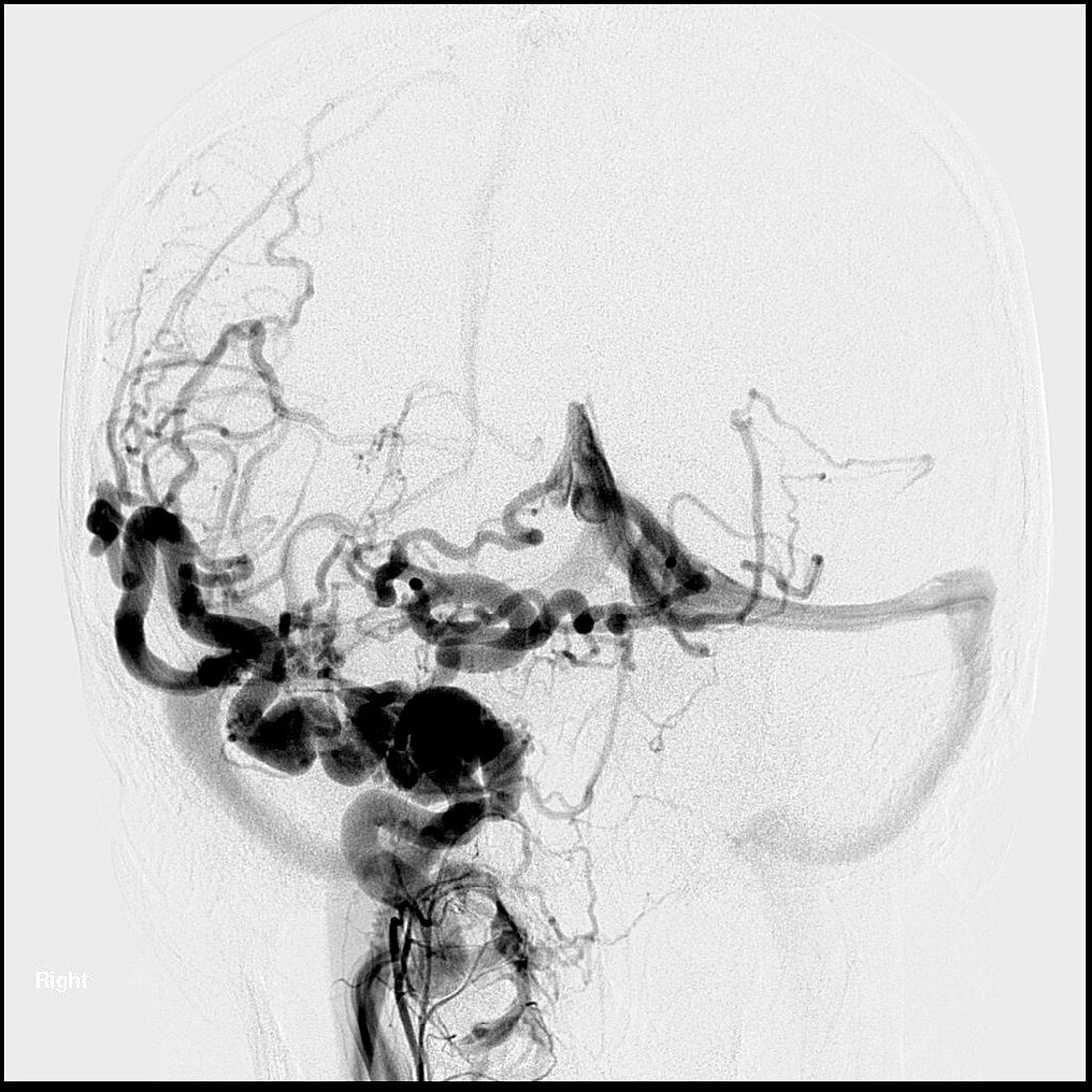 Carotid Cavernous Sinus Fistula,MRI