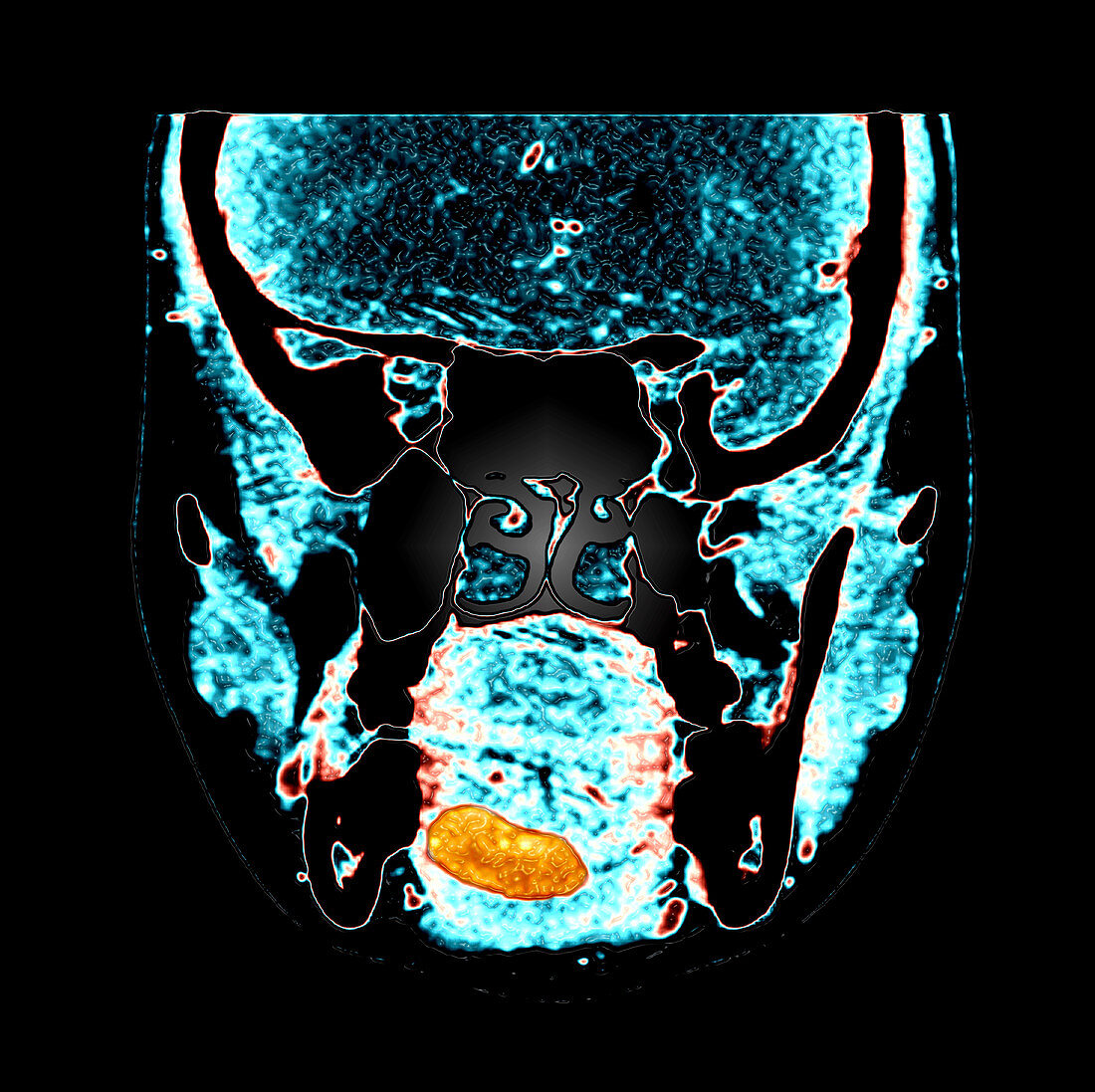 Lingual Thyroid,CT Scan
