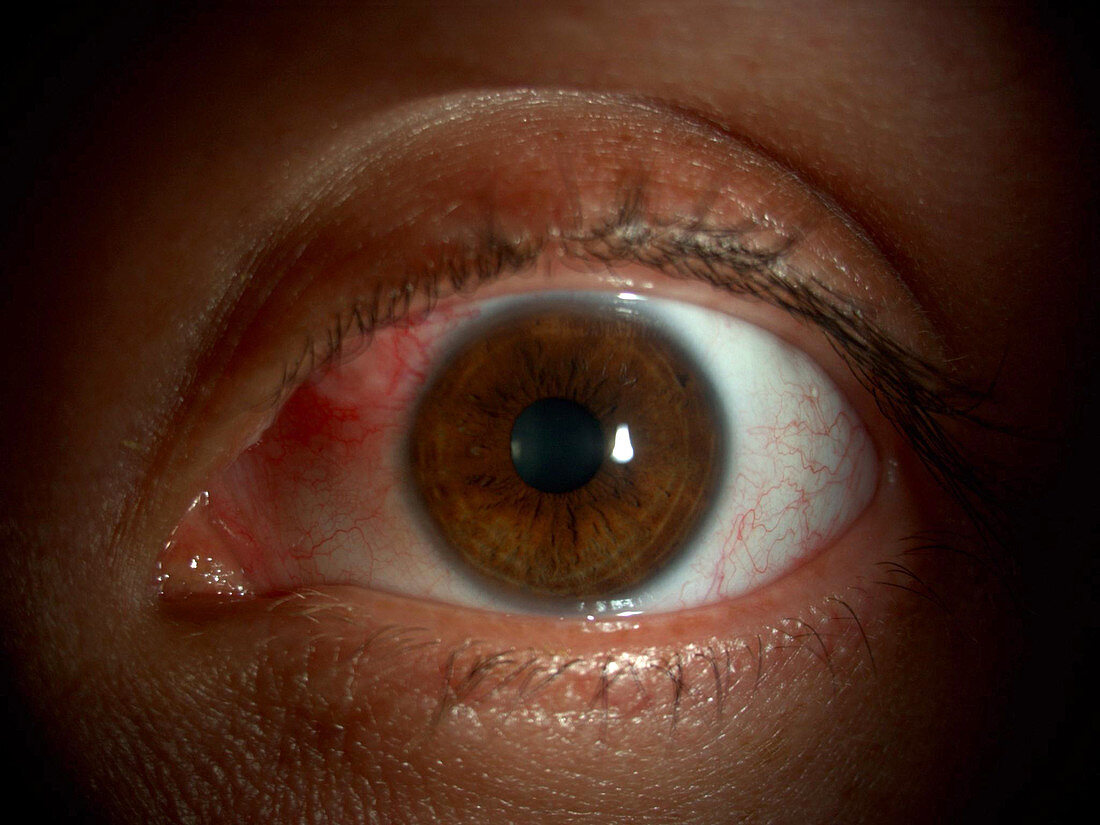 Episcleral Nodule in Eye