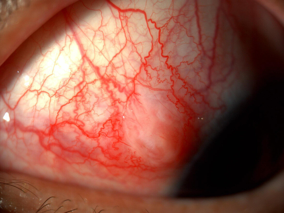 Episcleral Nodule in Eye