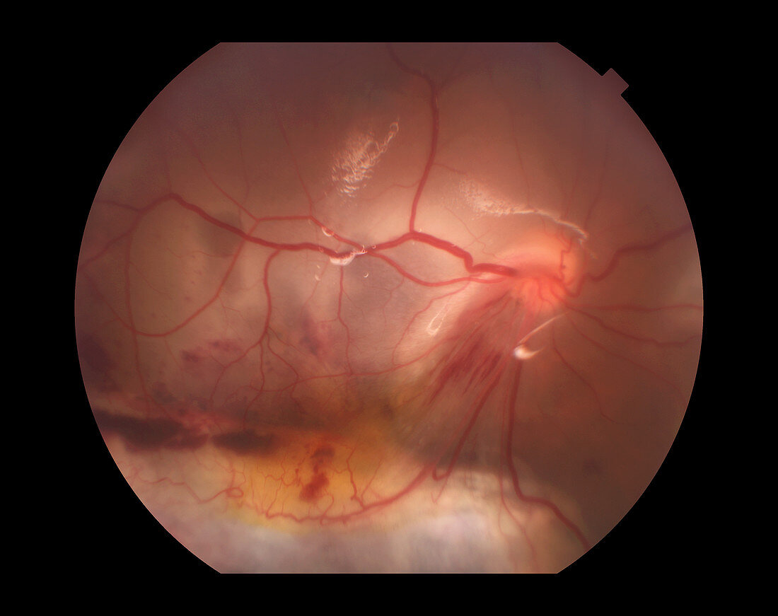 Retinal Knife Wound