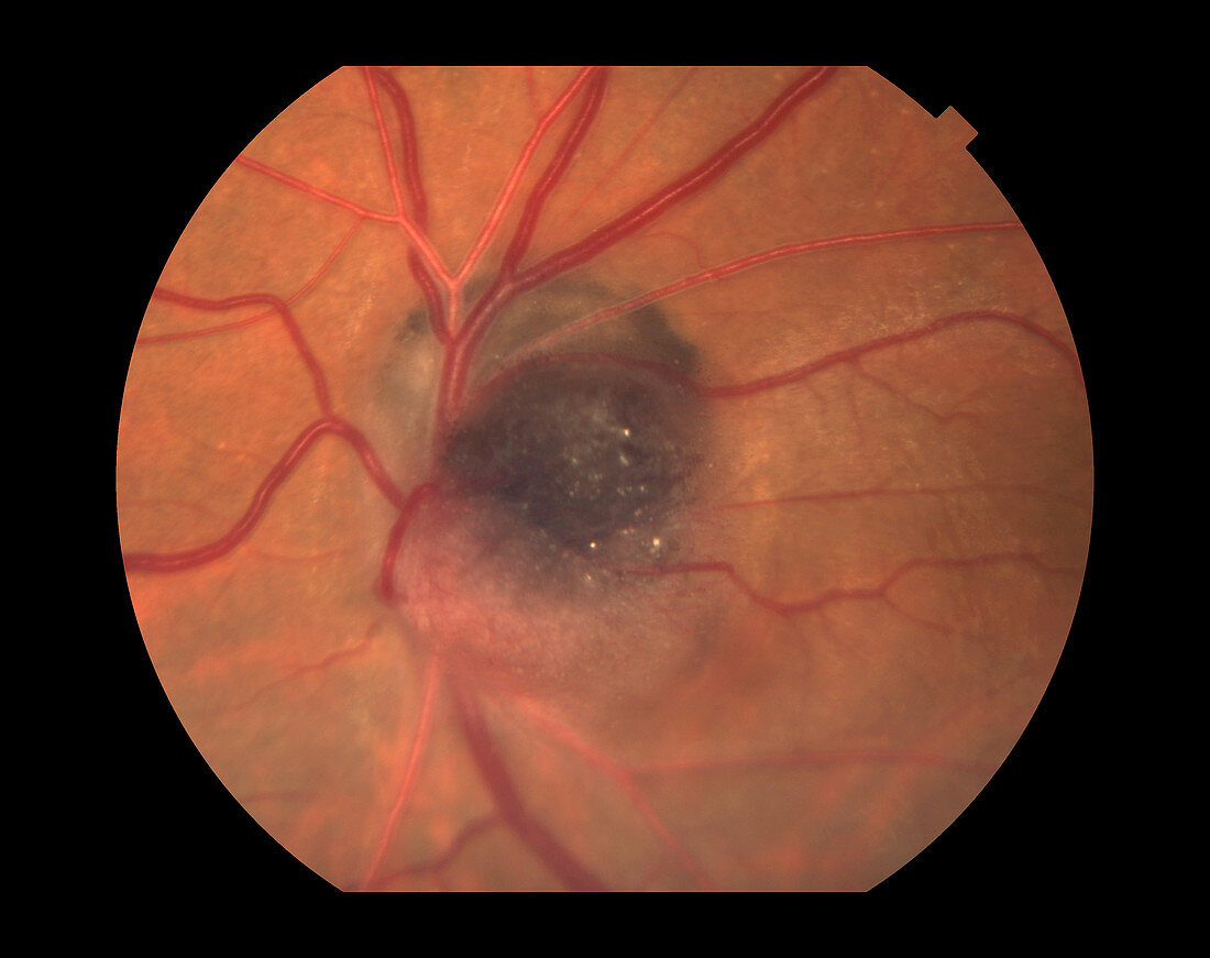 Melanocytoma