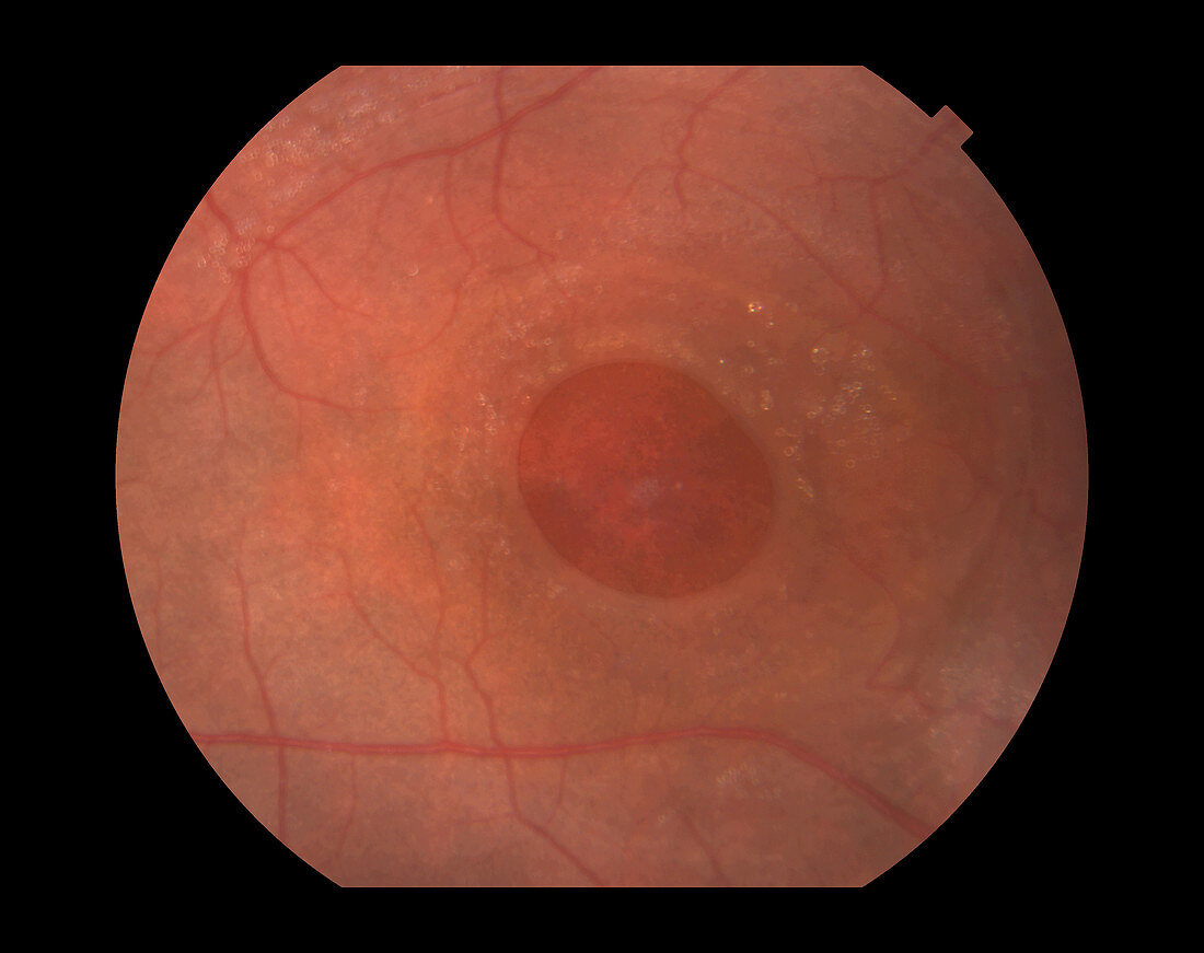 Macular Hole,Ophthalmic Medicine